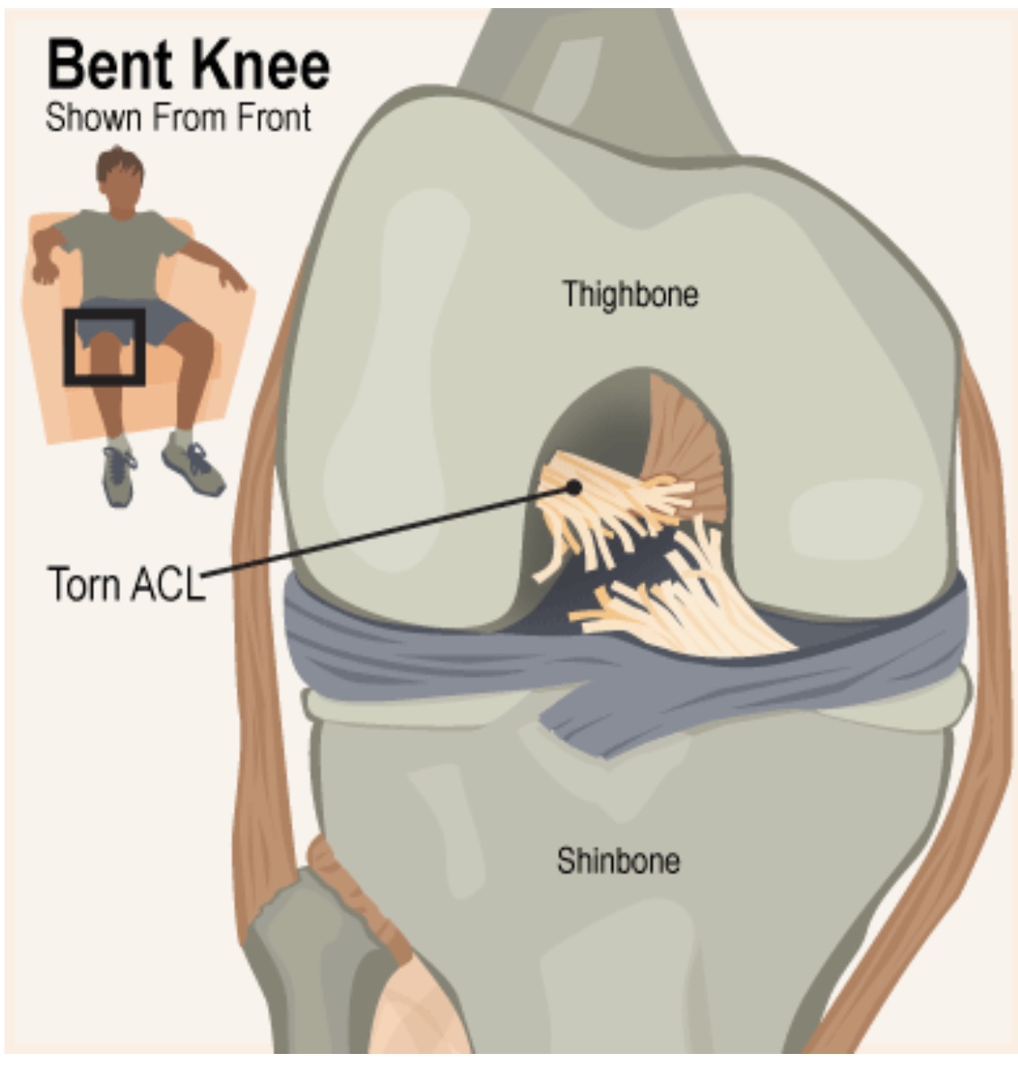 Why does my knee hurt 1 year after ACL surgery?
